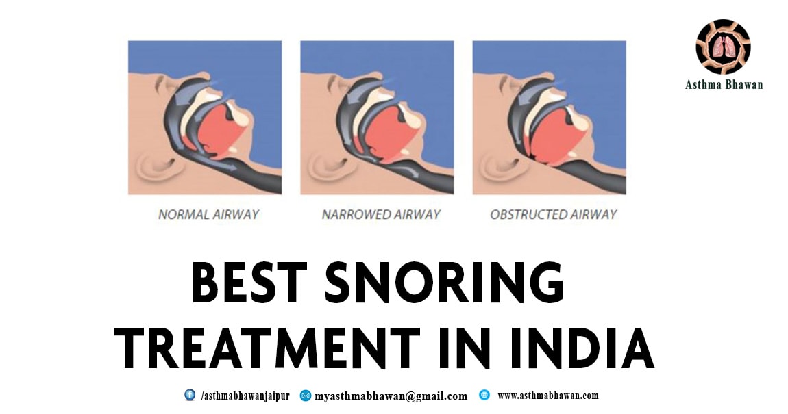 best Snoring Treatment In India