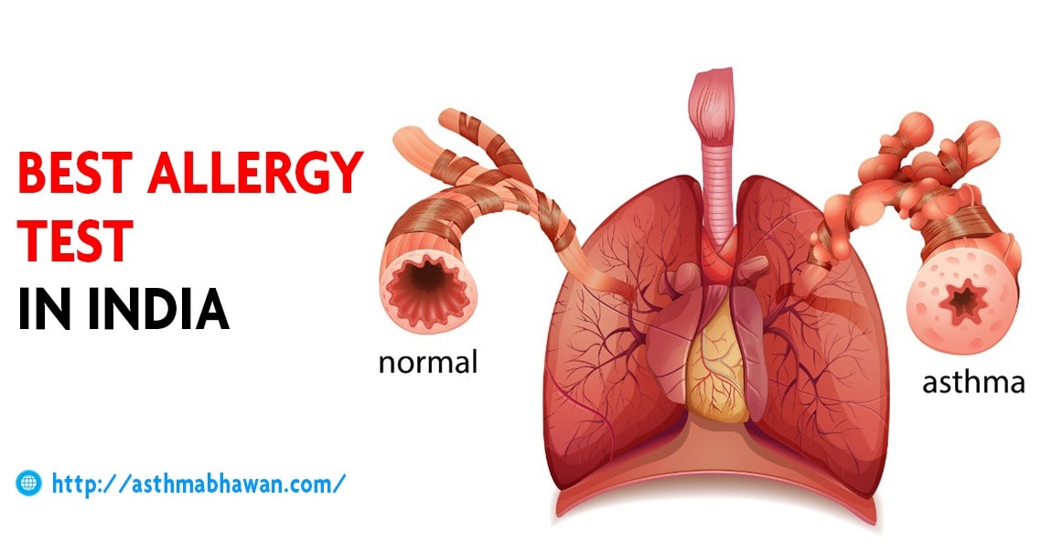 Best Allergy Test In India - Asthma Bhawan