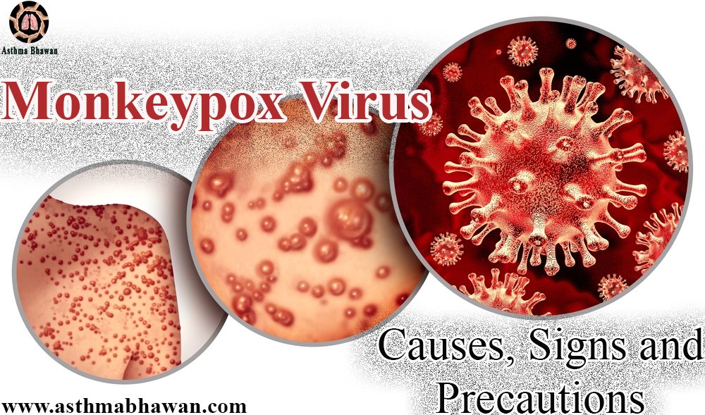 What is monkeypox and its signs and symptoms?