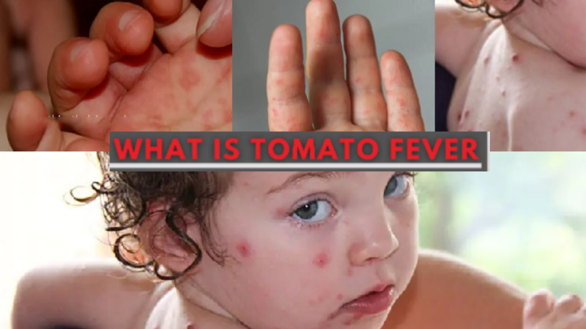 What is Tomato Flu or Tomato Fever? Know its Symptoms | Causes | Prevention